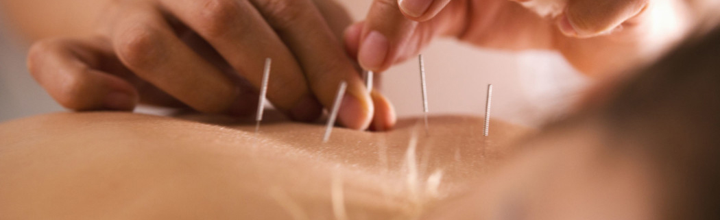 Hender som setter akupunkturnåler i ryggen til en person. Foto.